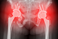 髋骨骨折患者问：髋骨骨折的治疗方式有哪些？