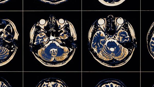 诺华发布IgA肾病新药研究中期结果，蛋白尿降幅达38.3%
