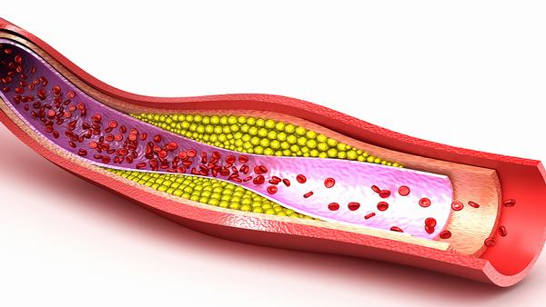 如何预防甲羟戊酸激酶缺乏症的复发