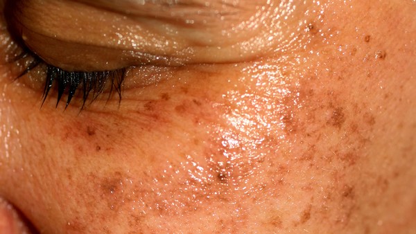 治疗恶性固体肿瘤吃什么药