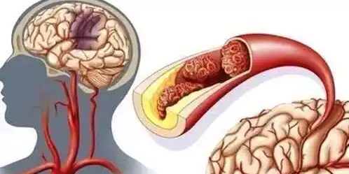 清晨疾病高发，如何保护心脑健康？