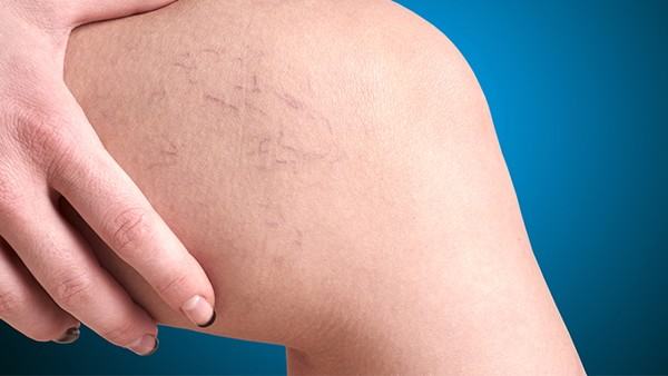 紫癜的发病原因是什么