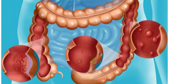 肠癌防治需及早发现，检查、发现、治疗的重要性