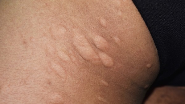 杜氏肌营养不良症是怎样形成的