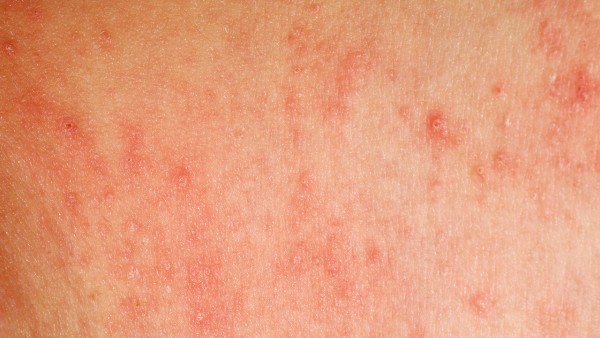 预防膀胱癌需要注意哪些事项