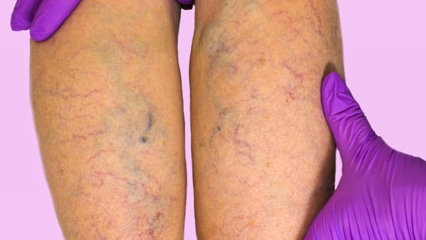 多毛症是怎样形成的