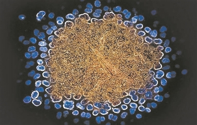 艾滋病治愈的希望之光：从干细胞移植到基因疗法