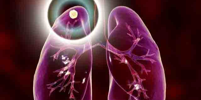 C-Lung-RADS：为中国人群量身定制的肺结节风险分级系统