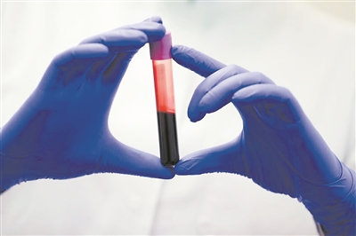 揭开输血失败的谜团：MAL血型系统的发现与AnWj抗原的作用