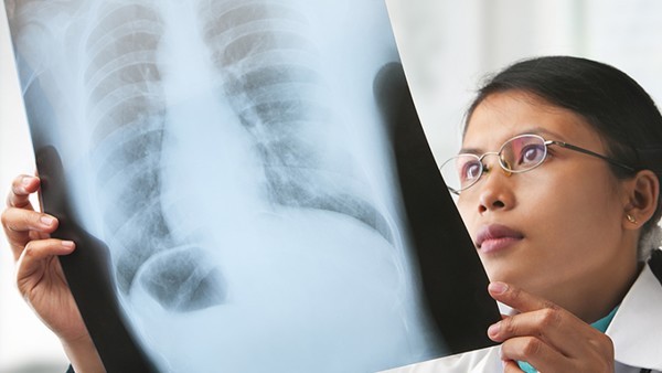 系统性红斑狼疮的治疗费用