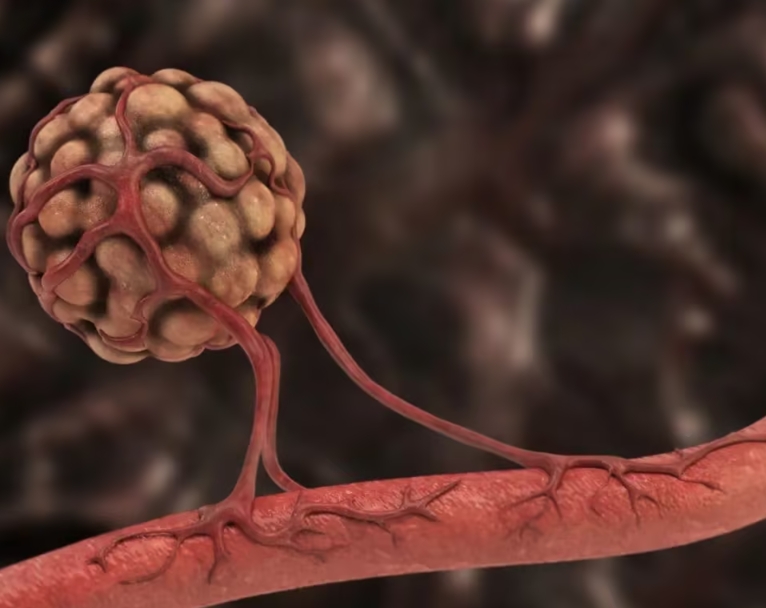 Sotatercept新药抢先登陆澳门，为肺动脉高压患者带来新希望