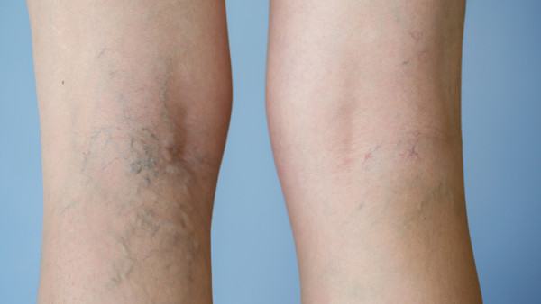 慢性阻塞性肺疾病患者的运动建议