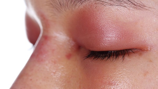 支气管扩张的预防与治疗指南