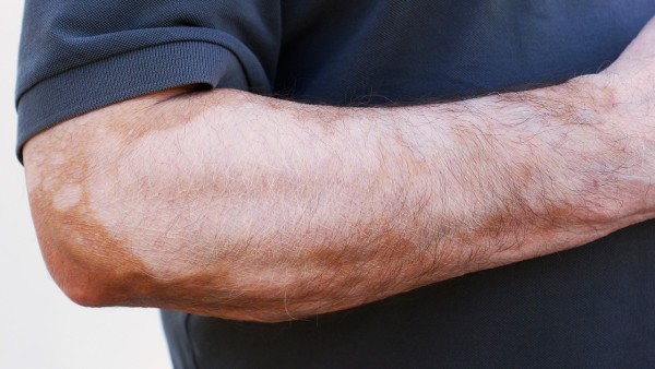 过敏性湿疹如何通过改善饮食来治疗