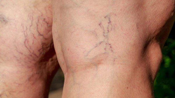 肾上腺皮质功能减退症的情绪管理