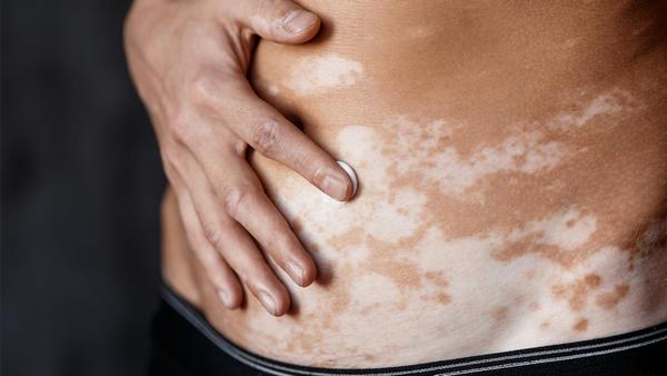 家族性地中海发热的治疗费用