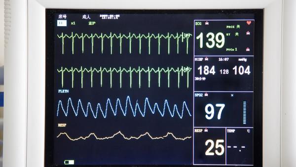 Rett综合征会导致癫痫吗？