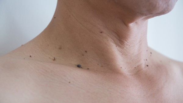 脊柱型关节炎的症状减缓技巧