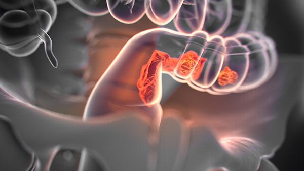 心绞痛患者的饮食建议